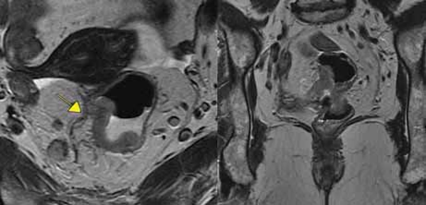 Tumor s extramurální vaskulární invazí+, vlevo transverzální rovina, vpravo
koronární rovina. 