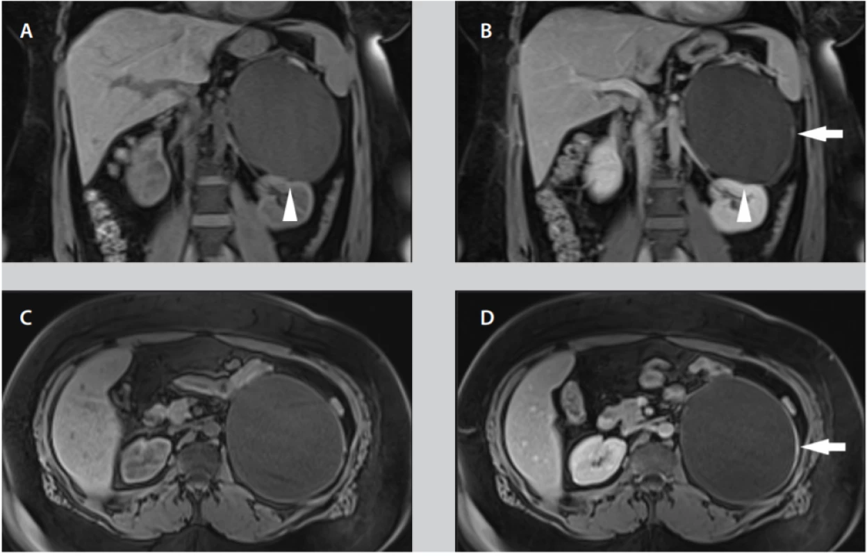 A–D. Při MRI vyšetření je patrný obraz objemné cystické léze v oblasti levé ledviny, dislokuje ji kaudálně. V místě naléhání na ledvinu je jemná nepravidelnost kontury (hlava šipky 1A, B) naznačující možný původ z ledviny. Po aplikaci kontrastní látky je patrné sycení mírně zesílené stěny (bílá šipka 1B, D); A – nativní T1 vážený obraz v koronální, B – postkontrastní T1 vážený obraz v koronální
rovině, C – nativní T1 vážený obraz v transverzální rovině, D – postkontrastní T1 vážený obraz v transverzální rovině.<br>
Fig. 1A–D. MRI examination reveals a large cystic lesion adjacent to the left kidney that dislocates it caudally. There
is a slight irregularity of the cyst contour at the kidney contact point (arrowhead 1A, B) indicating the origin from the
kidney. After the application of contrast agent, there is an enhancement of slightly thickened wall (white arrow 1B, D);
A – coronal unenhanced T1 weighted image, B – coronal contrast-enhanced T1 weighted image, C – axial unenhanced
T1 weighted image, D – axial contrast-enhanced T1 weighted image.
