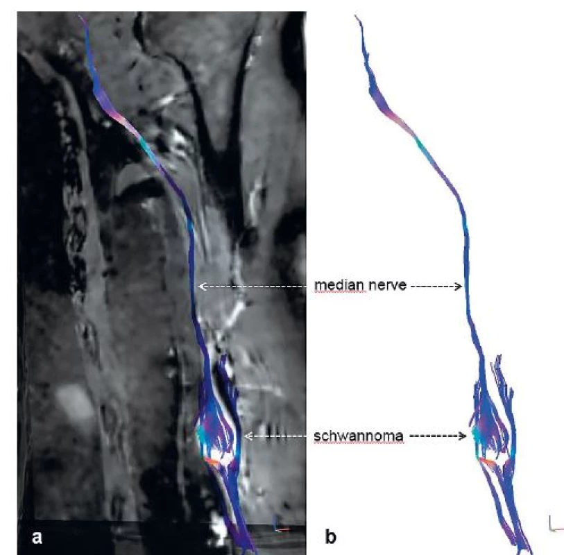 3D MR tractography (MRT) of schwannoma of the median nerve – (a) neural fascicle
projection into basic structural images of conventional MRI and (b) isolated MRT reconstruction