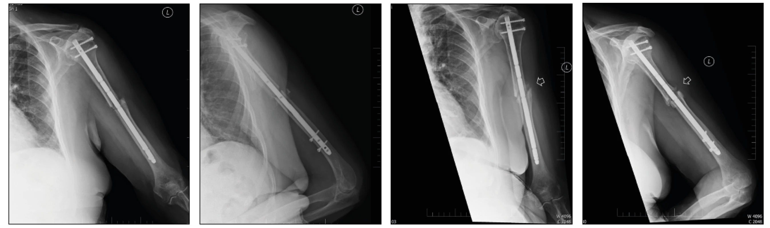 Radiograph of the humerus in anteroposterior and lateral projections. Postoperative radiograph (1a) and radiograph taken 13 months after injury (1b) depict a nail osteosynthesis of diaphyseal humeral fracture type A3. A non-union developed due to insufficient proximal fixation of the nail and associated instability at the fracture site