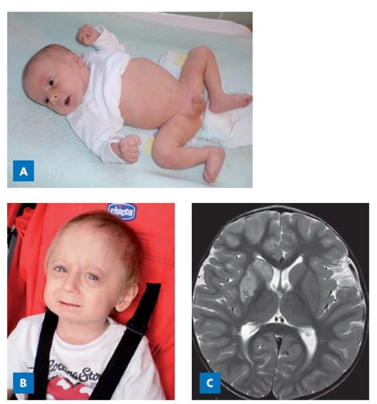 Chlapec s Hutchinsonovou–Gilfordovou progerií (HGPS)
v důsledku patogenní varianty genu LMNA. A – ve věku 1 měsíc.
B – ve věku 3 roky. C – příčinou smrti ve 4 letech byla ischemie
oblasti bazálních ganglií vpravo a kortexu a subkortikálních oblastí
frontálního laloku vpravo.