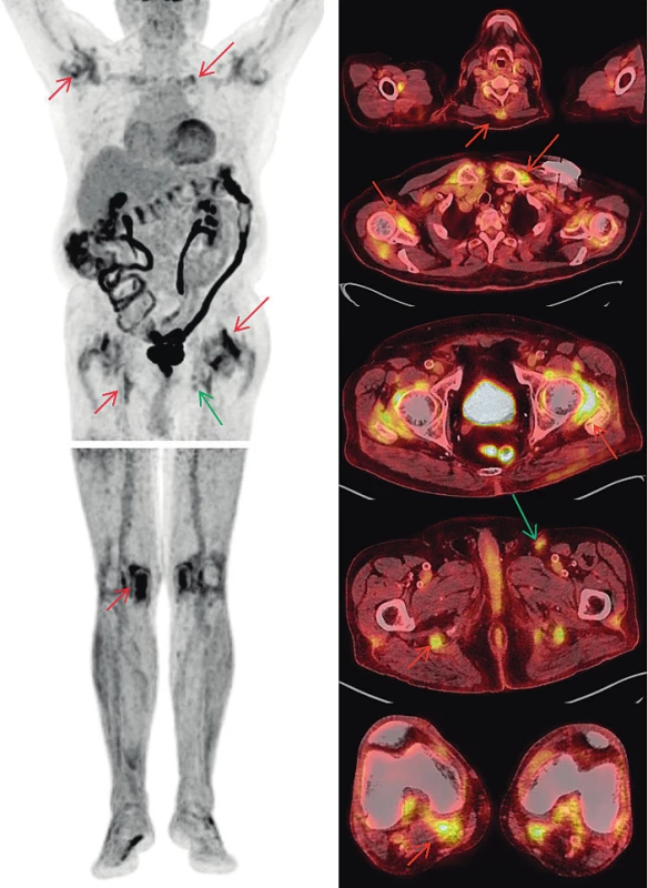 FDG-PET/CT vyšetření – MIP obrazy odpovídající
rozložení radiofarmaka FDG v trupu a dolních končetinách (vlevo)
a fúzované PET/CT obrazy v axiálních řezech (vpravo).
Nález odpovídající melanomu (zelené šipky): tři zvětšené uzliny
v levém třísle do 20 mm vykazují jen mírně zvýšenou akumulaci FDG
(pokles proti předchozím vyšetřením svědčící pro regredující nález).
Nález odpovídající PMR (červené šipky): Zvýšená akumulace FDG
kolem ramenních, sternoklavikulárních, kyčelních i kolenních kloubů,
kolem hrbolů sedacích kostí), v náznaku i u trnových výběžků
obratlů krční páteře. Zvýšená akumulace FDG v celém tračníku je
obvyklým nálezem provázejícím terapii metforminem.