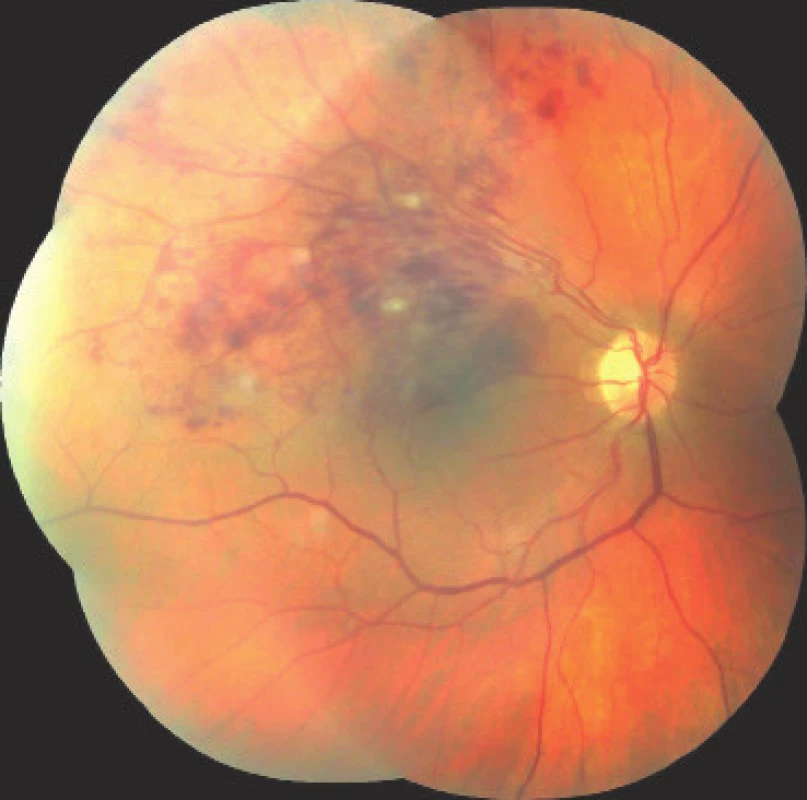 Retina of right eye in patient with occlusion of superior temporal branch of central
retinal vein – image obtained upon indication of intravitreal treatment with ranibizumab, on
the retina there is a finding of spattered haemorrhages and cotton wool spots in the central
region and in the upper temporal quadrant of the retina, best corrected visual acuity in the
right eye at the time of indication is 6/30