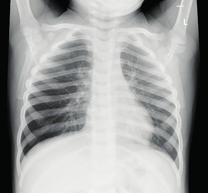 RTG snímek po suspektní aspiraci. <br>Fig. 1. X-ray of supposed aspiration.