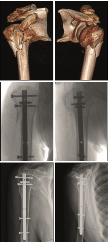 Woman 76 years old, fall at home, AO C3.1 fracture, operation on day 6 from the injury (transferred from other site + warfarinization), x-ray healing in 24 weeks, resulting elevation of 160°