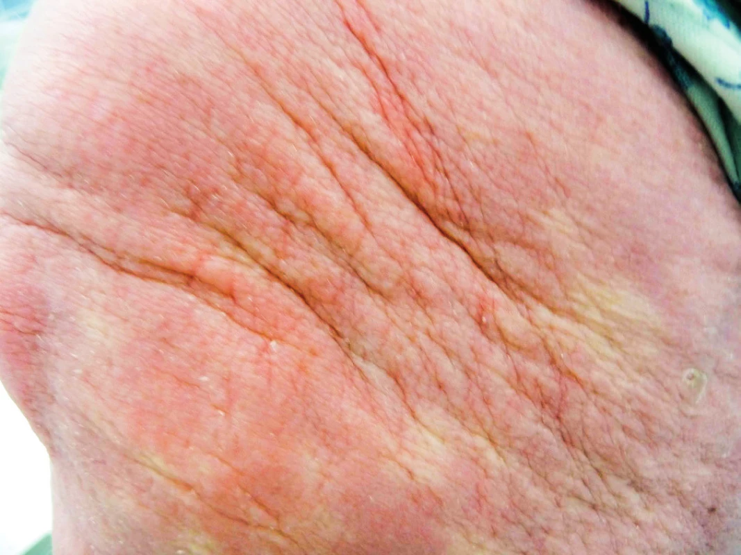 Struktura ztluštělé kůže pacientky se skleromyxedémem