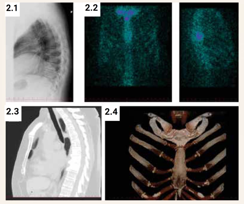 RTG, CT a scintigrafický nález u 55leté ženy s Pagetovou kostní chorobou v oblasti hrudní páteře (Th7-
Th9) a manubria sterna. (2.1) RTG nález: deformační spondylóza Th-páteře, na LS páteři osteochondróza
L5/S1 s lokalizovanou def. spondylózou, spondylartróza (2.2) Scintigrafický nález: nehomogenní distribuce
radiofarmaka v páteři, zvýšená osteoblastická aktivita se zobrazuje v těle přibližně Th8, méně i Th7 a Th9.
Zvýšená akumulace radiofarmaka je patrná v manubriu sterna a sternoklavikulárním a 1. sternokostálním
skloubení (2.3) CT nález: masivní sklerotická přestavba tvarově nezměněných těl Th8 a Th9, částečná i Th7.
Výrazná defigurace jen v podobě objemných zobákovitých převážně ventrálních spondylofytů, které svědčí pro
chronicitu přestavbového kostního procesu. Kanál i foramina beze změn (2.4) CT hrudníku s doplněním kostní
rekonstrukce: shodným procesem kompletně postiženo i manubrium sterna a přilehlé konce prvních žeber.
Přestavba je charakteristická pro Pagetovu kostní chorobu.