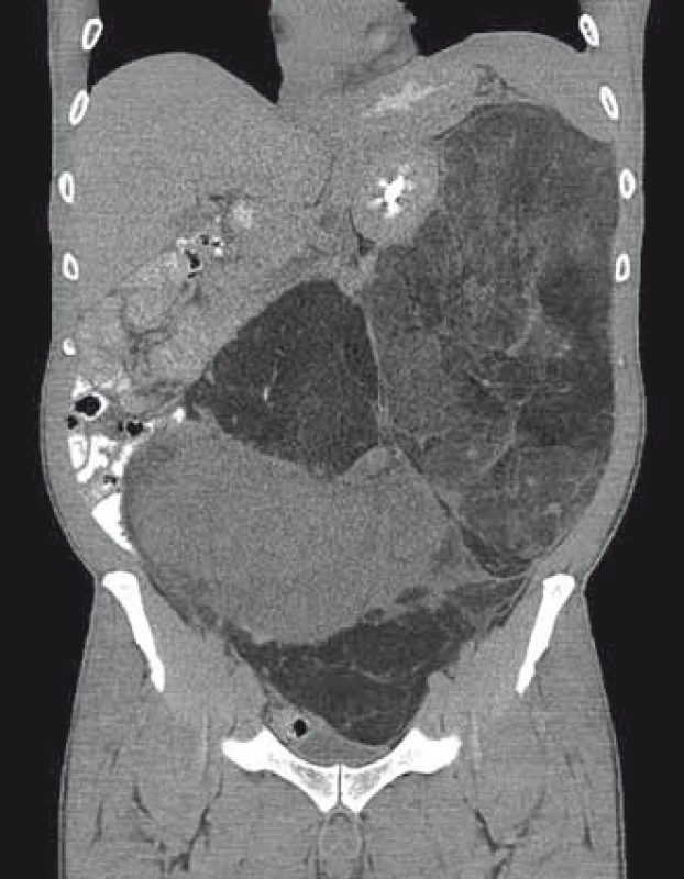 CT snímky pacienta s enormním liposarkomem retroperitonea.