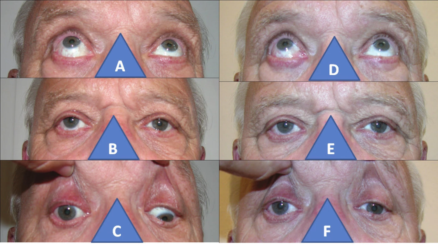 67-year-old man with post-traumatic palsy of inferior rectus muscle in right eye: increased elevation in right eye (A), hypetropia in right eye (B), zero depression in right eye (C), normalisation of elevation after surgery (D), parallel position of eyes after surgery (E), only indication of depression after surgery in right eye (F)