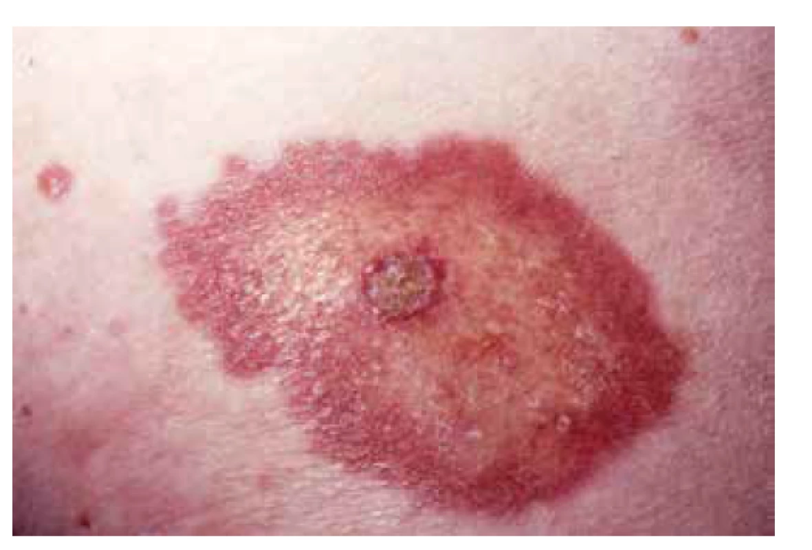 Necrobiosis lipoidica s počínající ulcerací