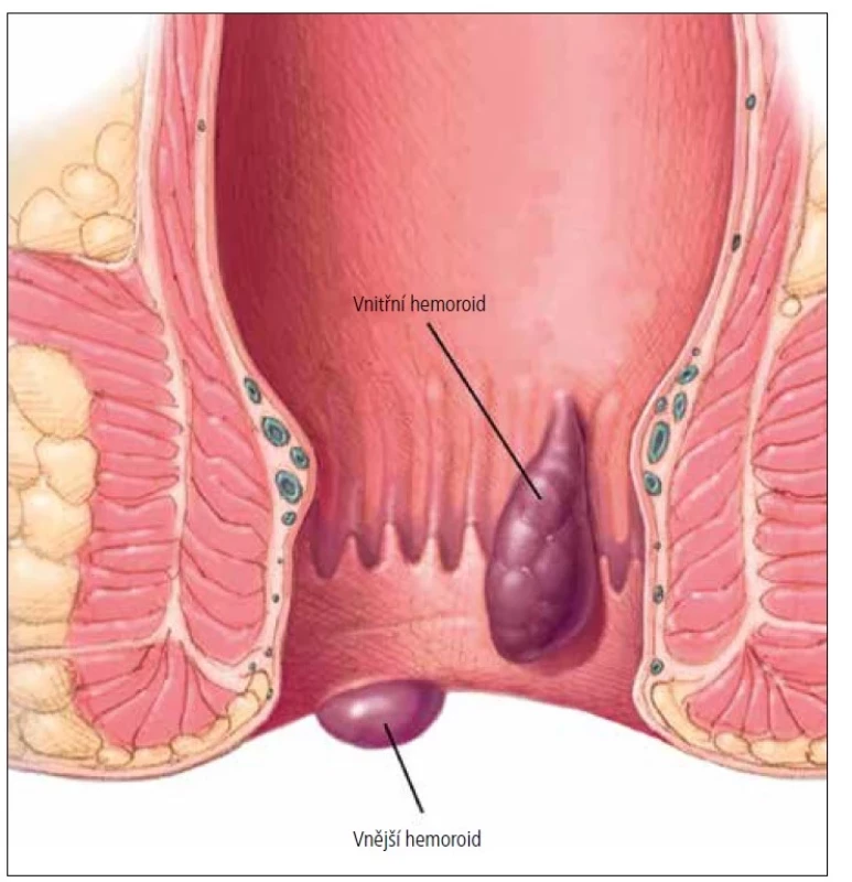 Vnitřní a zevní hemoroidy se zobrazením linea dentata.