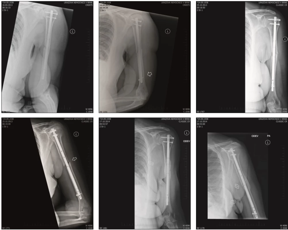 Radiograph of the humerus in anteroposterior and lateral projections, taken postoperatively (3a), 9 months (3b) and 18 months (3c) after injury. The images show a nail osteosynthesis with distal fixation using one screw. No progression of fracture healing  is observed  9 months after the procedure. The perfomed decortication and spongioplasty resulted in healing of the fracture 18 months after the initial trauma (3c)