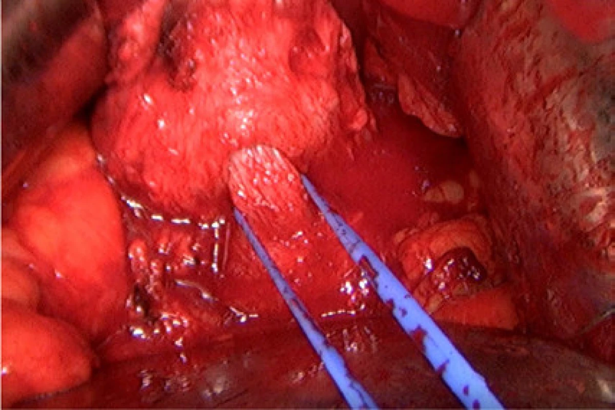 Hrdlo je kompletně uvolněno a zavěšeno na
tkanici<br>
Fig. 3. The bladder neck is dissected completely and
fixed with a tape