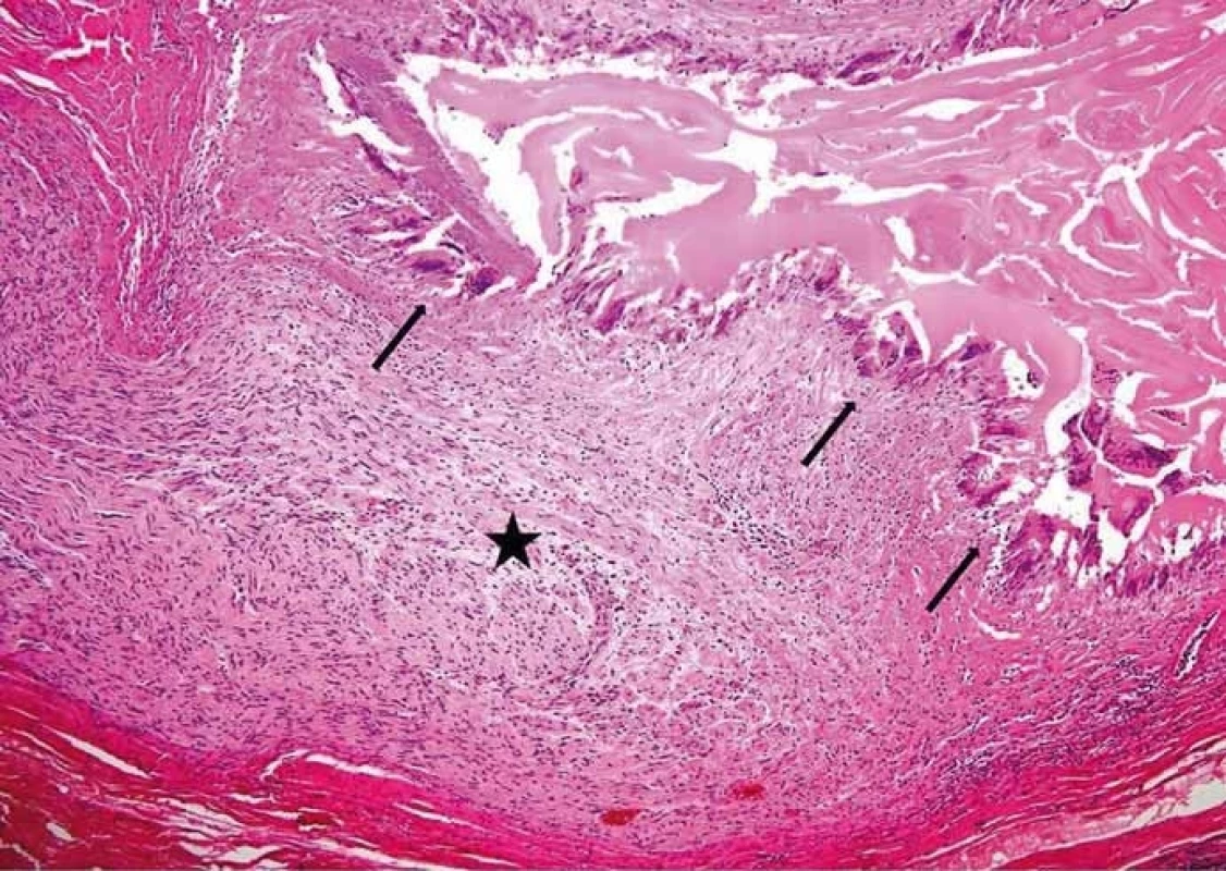 Perineurální šíření echinokoka. Hvězdička v nervu, šipky ukazují na struktury echinokoka (barvení hematoxylin-eozinem, původní zvětšení 100×). (Zdroj: MUDr. Hana Skopcová).<br>
Fig. 4. Perineural spread of echinococcus. The star is in the nerve; arrows show the echinococcal structures (hematoxylin-eosin staining, original magnifi cation ×100). (Author: MUDr. Hana Skopcová).