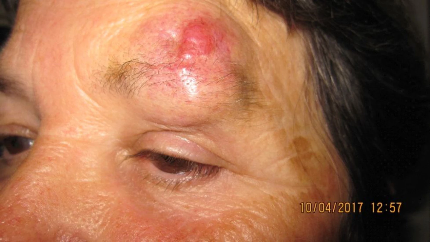 Patient 2 – detail of lesion in part of upper eyelid and
supercilium in April 2017