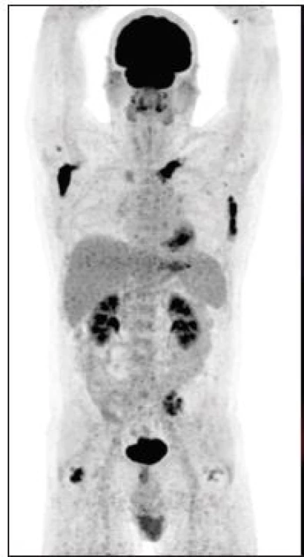 (vlevo) Sumarizace nálezů
<sup>18</sup>F-FDG PET/CT vyšetření
u pacienta č. 5. Černobílá
MIP projekce ukazuje rozsah
snímání, odráží i rozsah kostního
postižení ve snímaném
rozsahu. Fúzované obrazy pak
ukazují detaily hypofyzárního,
paranasálního i kostního postižení.