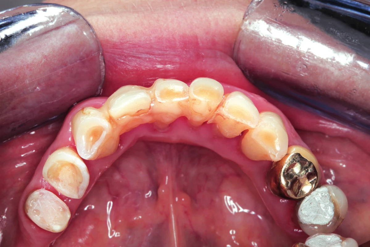 Atrice zubů dolní čelistí