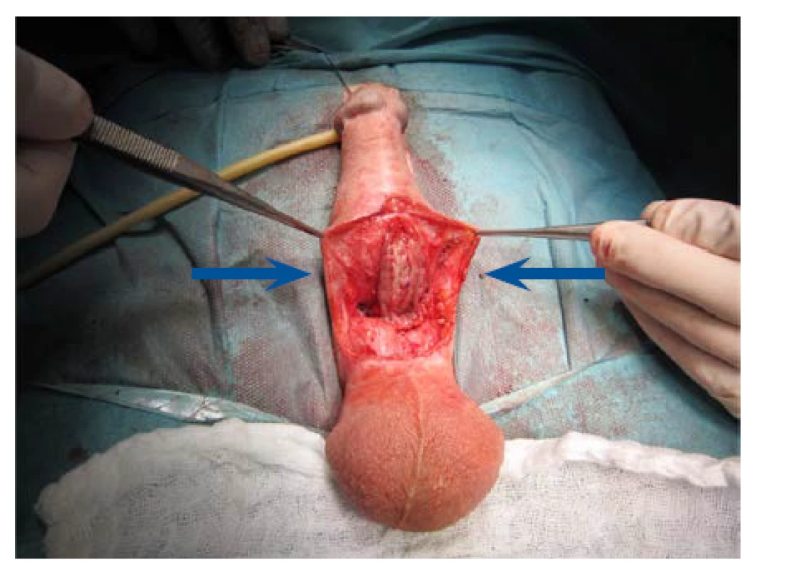 Fixace bukálního štěpu dle Asopy dorzálně,
okraje uretry před suturou a tubulizací<br>
Fig. 17. Fixation of the buccal graft dorsally according to
Asopa; urethral edges prior to suturing and tubularization
