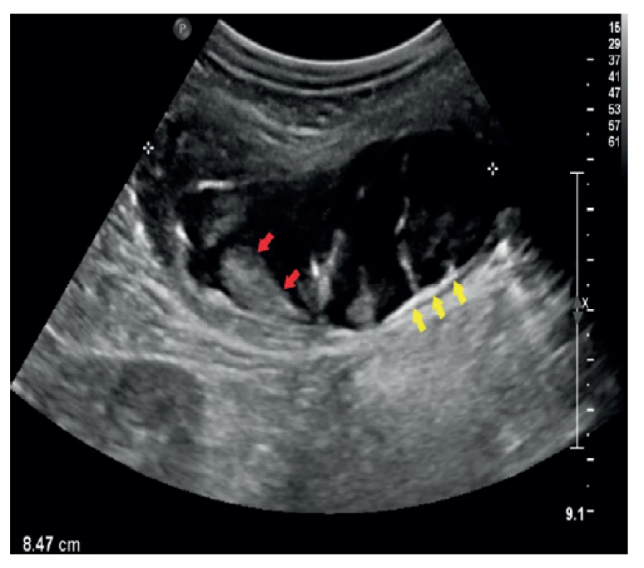 UZ obraz mukokély apendixu – longitudinálně<br>
Sonografie břicha stejného pacienta. V oblasti céka tubulární,
převážně anechogenní útvar, který je částečně vyplněn
echogenním obsahem (červené šipky). V dorzální části stěny
patrné echogenní kalcifikace (žluté šipky). Klinika radiologie
a nukleární medicíny FN Brno a LF MU.<br>
Fig. 2: Ultrasound image of appendiceal mucocele – longitudinal
projection<br>
Sonography of the abdomen of the same patient. A tubular,
mostly anechogenic formation is present in the area of the
cecum, which is partially filled with echogenic content (red
arrows). Echogenic calcifications (yellow arows) are visible
in the dorsal part of the wall. Department of Radiology and
Nuclear Medicine, University Hospital Brno, Faculty of Medicine,
Masaryk University.