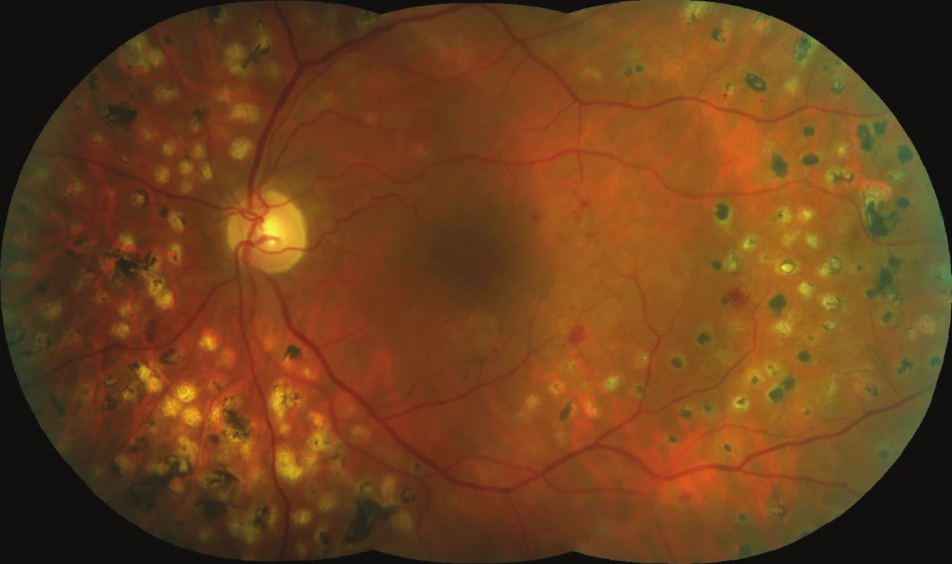 Initial fundus photography
of left eye: edema in the central
area, several microaneurysms
and intraretinal haemorrhages,
spots after partial panretinal
photocoagulation.