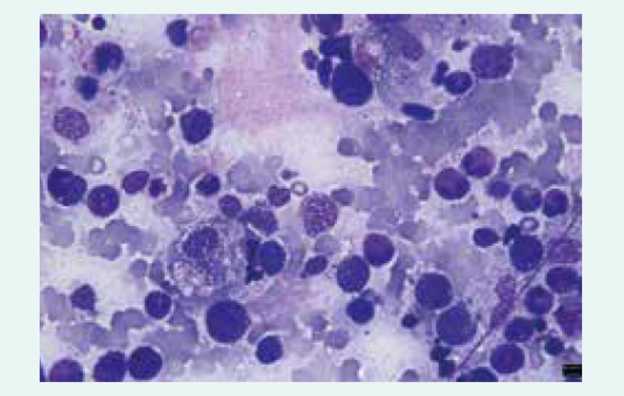 Hemofagocytóza v kostní dřeni nemocného
s HLH