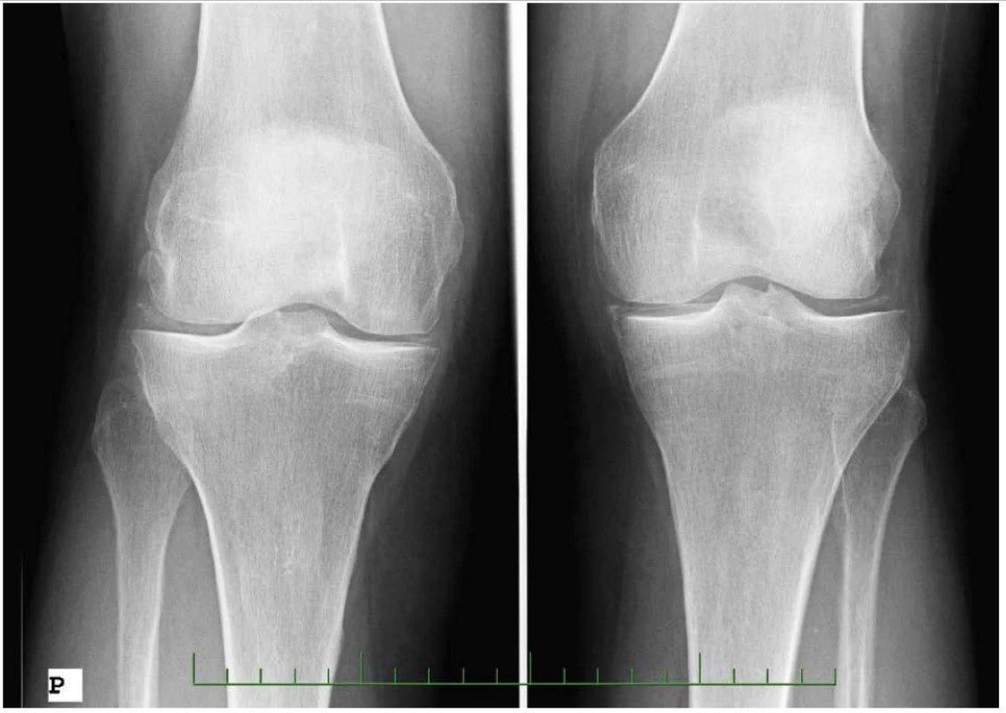 Nemoc z ukládání CPP krystalů, RTG snímky – RTG obou kolen, AP projekce: gonartróza stupeň II vpravo, stupeň I vlevo, kalcifikace menisků bilat (77letá pacientka s idiopatickou formou nemoci) 