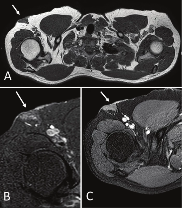 Magnetic resonance imaging (MRI). Axial T1-weighed (A), DP-weighed
fat-suppressed (B), and T1-weighed fat suppressed gadolinium enhanced (C).
Images demonstrate a superficial triangular shaped mass (white arrows),
isointense to muscle on T1 with homogeneous contrast enhancement
