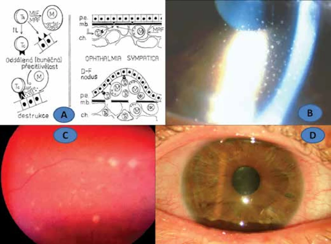Schema of type IV hypersensitivity (A), patient no. 2: fatty precipitates on corneal
endothelium (B), Dalen-Fuchs nodules in choroid (C), remission of SO with artephakia and
Express shunt (D)