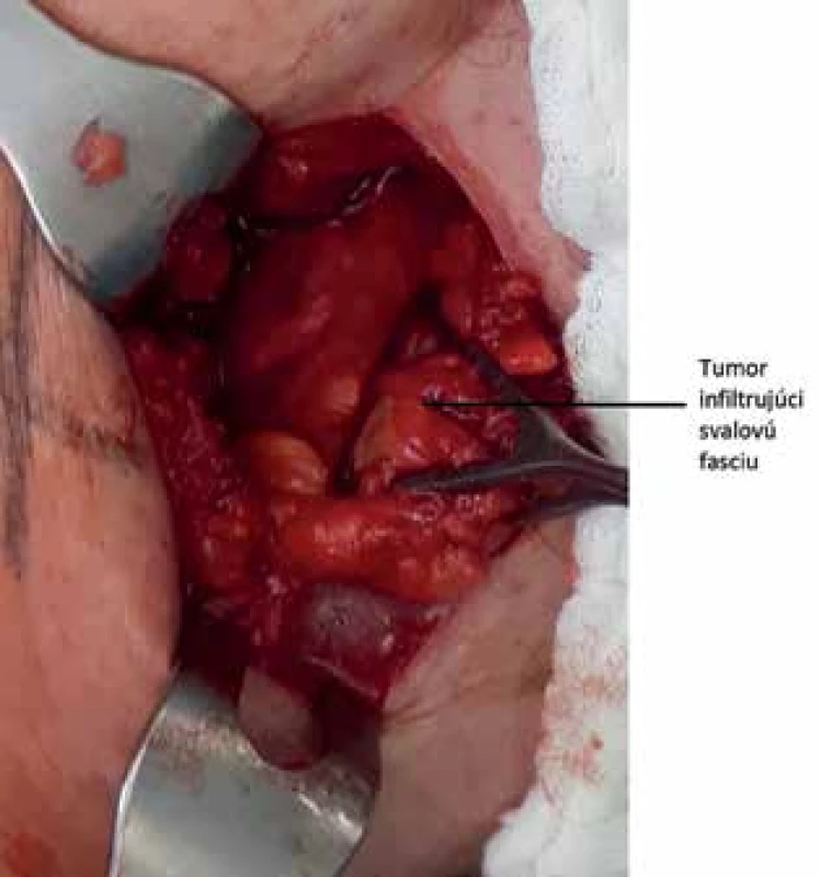 Tumor infiltrujúci svalovú vrstvu brušnej steny <br>
Fig. 2: Tumor infiltrating the muscular layer of the abdominal wall