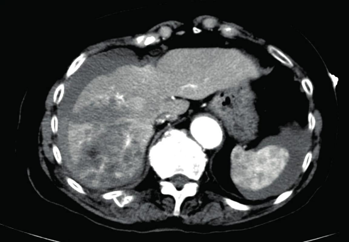 Liver laceration of the 4<sup>th</sup> degree