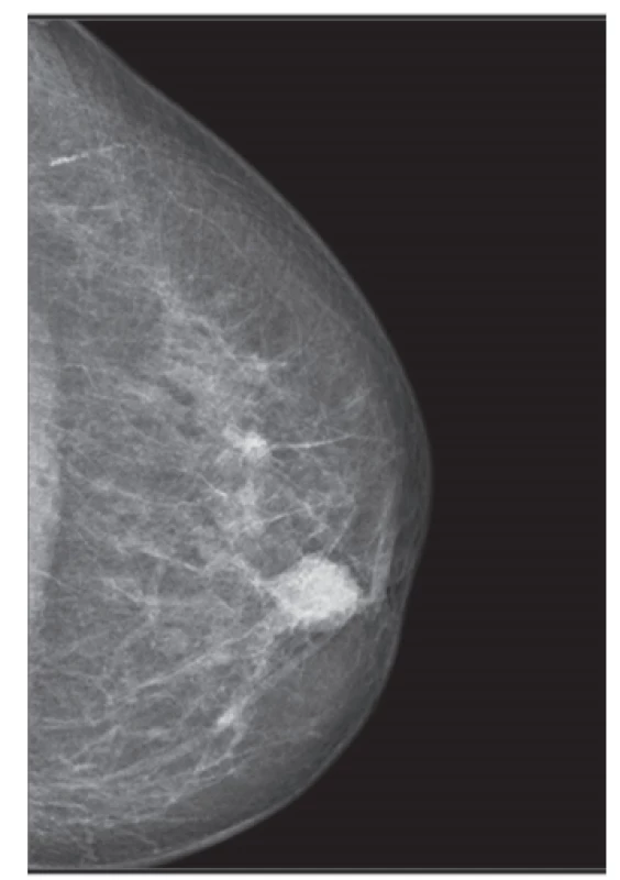 Karcinom prsu u seniorů − mammografie<br>
Fig. 2: Breast carcinoma in elderly patients − mammography