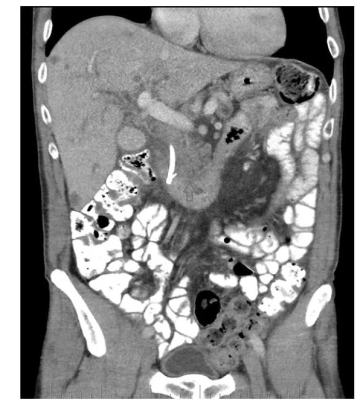 Šipka označuje tumor hlavy pankreatu, vlevo od něj stent, četné
hypodenzity jater jsou metastázy (se souhlasem publikováno z archivu
KZM FNUSA)