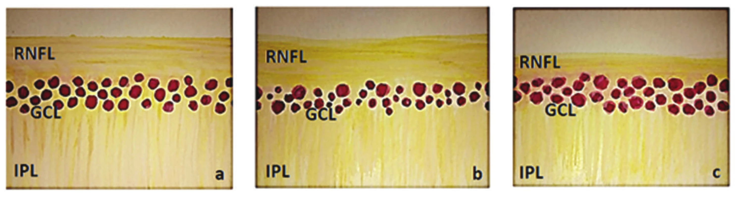 Schematic illustration of inner layers of retina (RNFL – retinal nerve fibre layer, GCL – ganglion cell layer, IPL – inner plexiform layer) a) normal finding, b) finding in HTG – reduction of GCL and slightly also RNFL, c) finding in NTG – reduction of RNFL and slightly also GCL