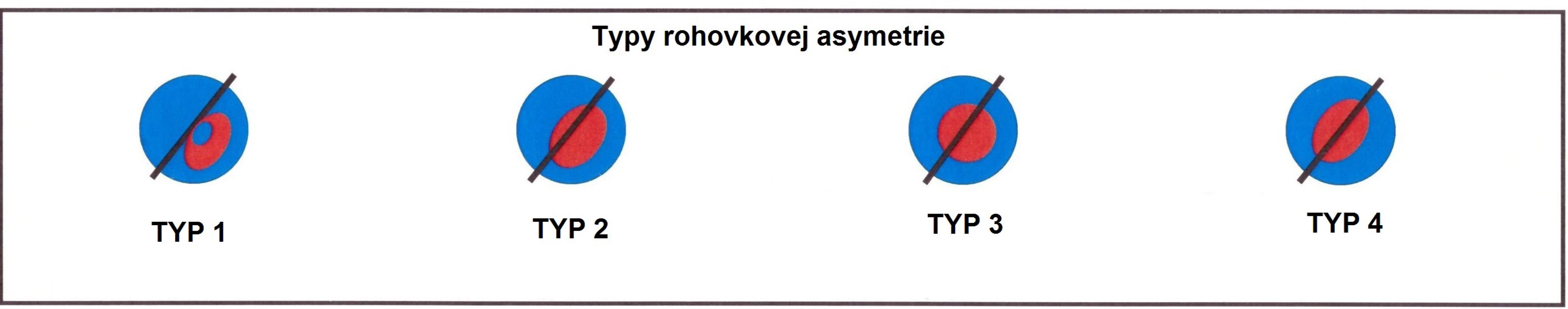 Types of corneal assymetry used for Keraring calculations