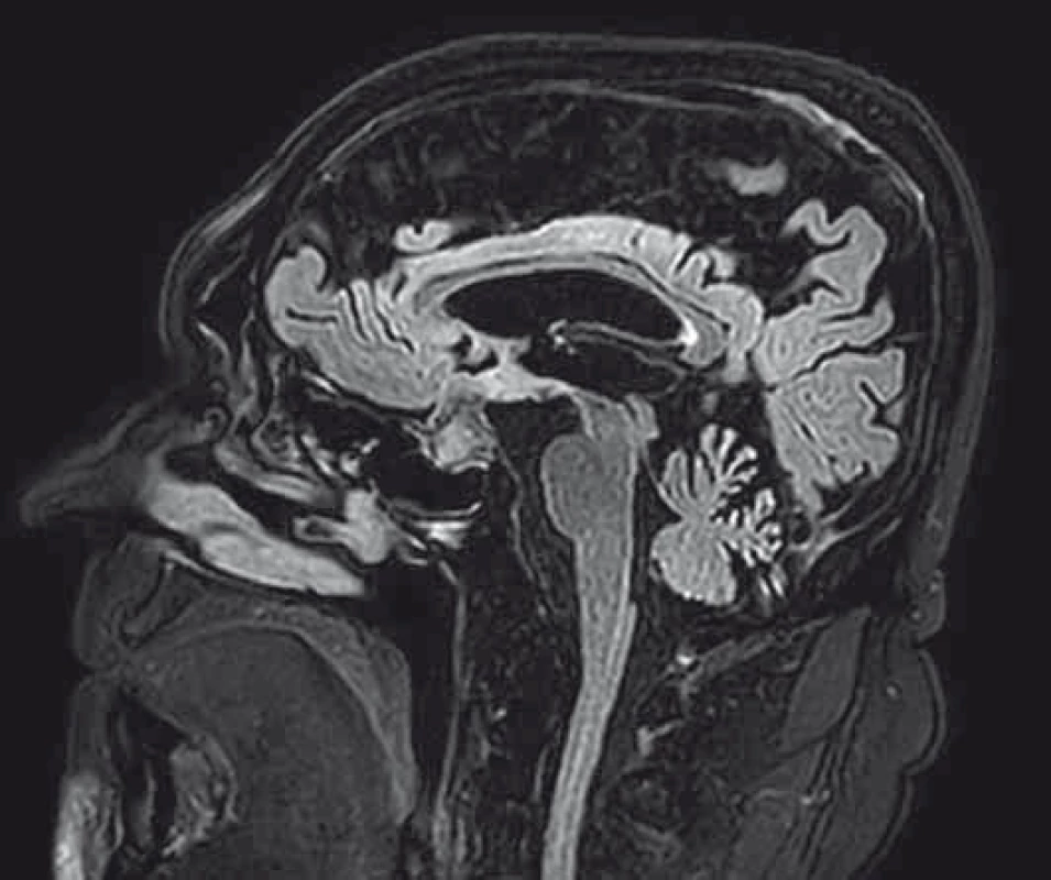 MRI hypofýzy.
