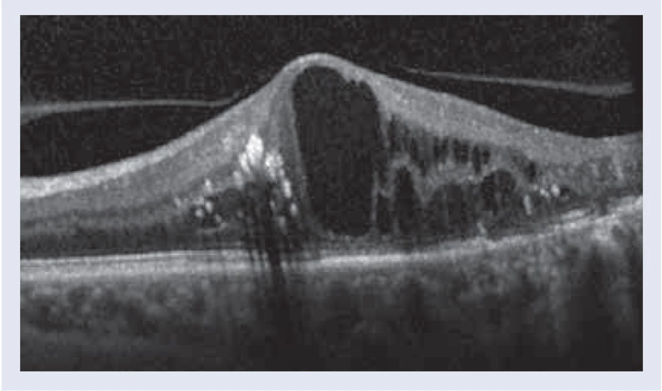 OCT-obraz, vitreomakulárna trakcia
s cystoidným edémom makuly, vo fovee rozsiahlejšia
cysta, CST 611 μm. Nález pred PPV.
Snímky – archív autorky.