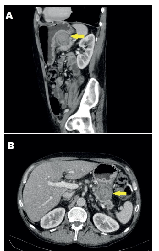 CT obraz suspektní léze sagitální řez (A) a tansverzální
řez (B)<br>
Fig. 1: CT scan of the suspected lesion from the sagittal
(A) and transversal view (B)