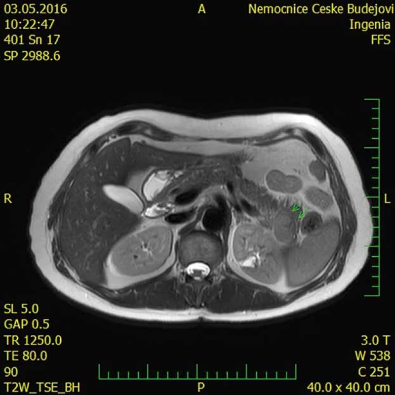 Intrapankreaticky uložená akcesorní slezina (IPAS) na magnetické rezonanci
(šipky).
Fig. 4. Magnetic resonance imaging scan showing an intrapancreatic accessory
spleen (IPAS) (arrows).