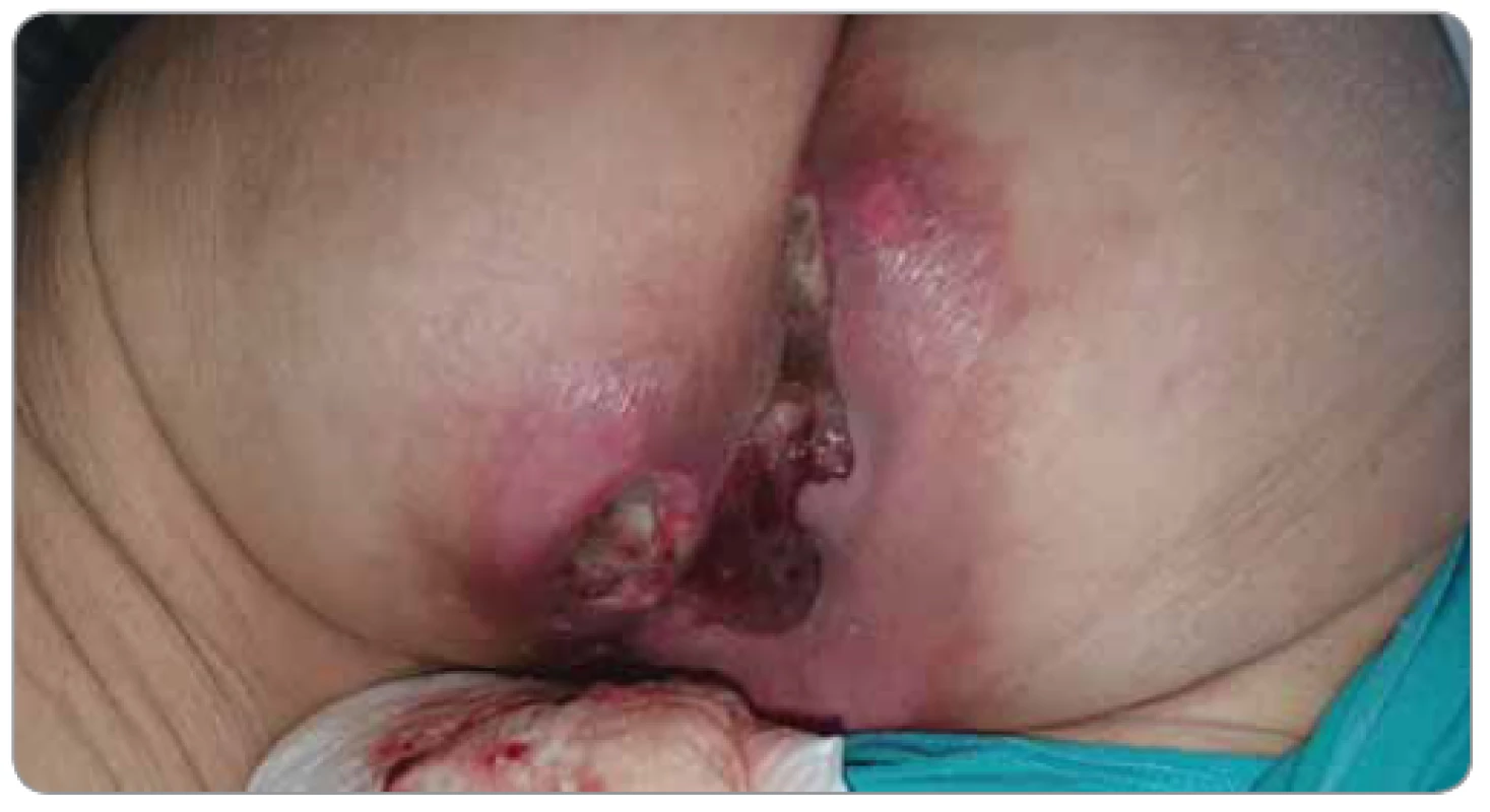 Pacientka s exulcerovaným recidivujícím karcinomem rekta. Masivní sekrece,
krvácení, zápach (foto S. Vokurka, FN Plzeň).