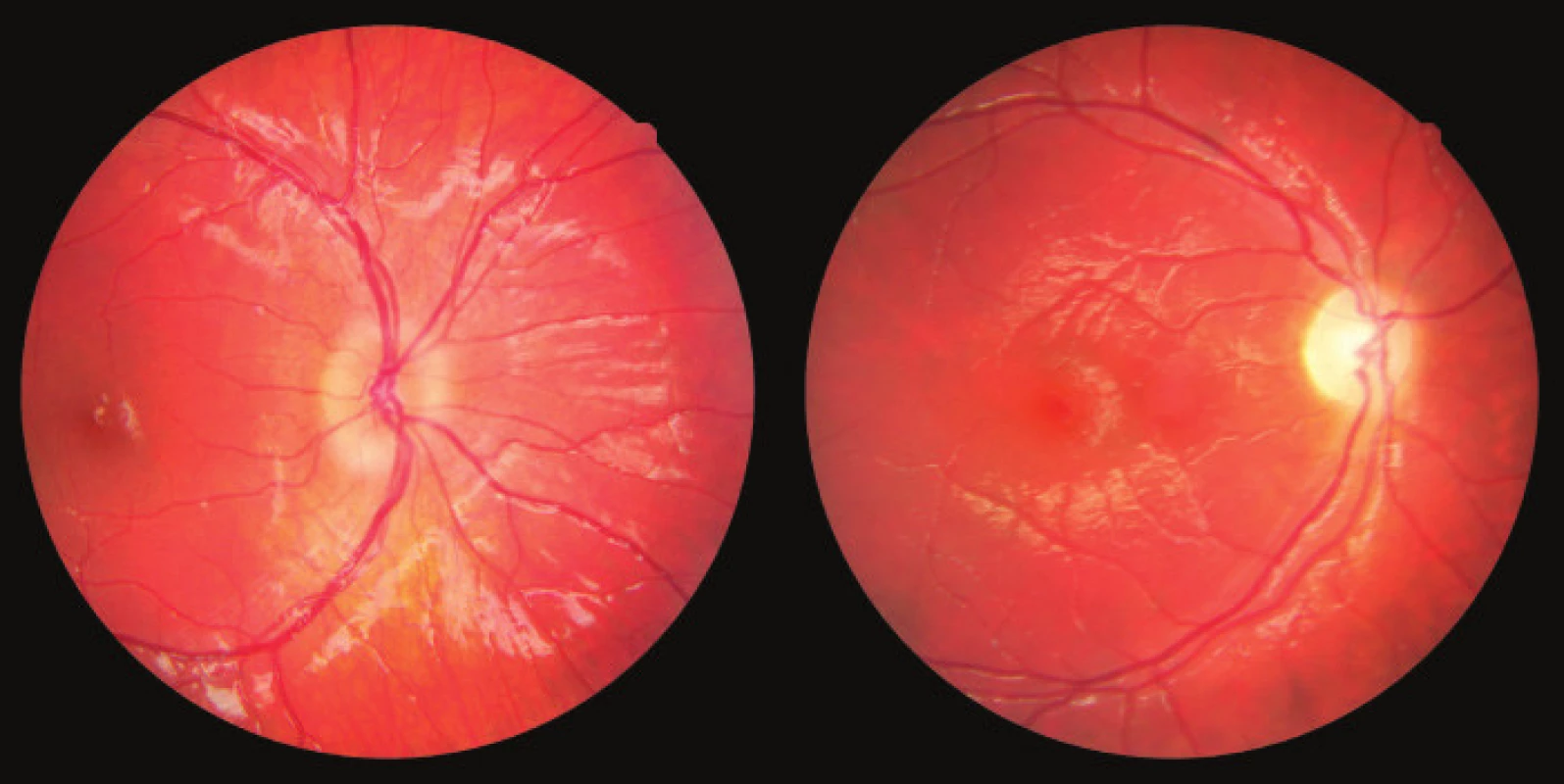 Photograph of fundus of OD: edema of papilla and
atrophy of papilla in patient with optic glioma
Source: Children’s Ophthalmology Clinic, Faculty of Medicine,
Masaryk University and University Hospital Brno