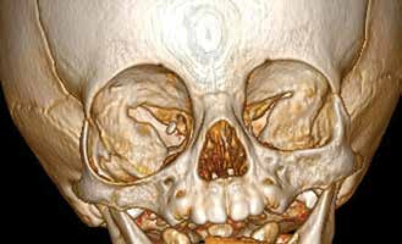 CT vyšetření v 9. měsíci věku s 3D rekonstrukcí
obličejového skeletu s patrným rozšířením pravé orbity