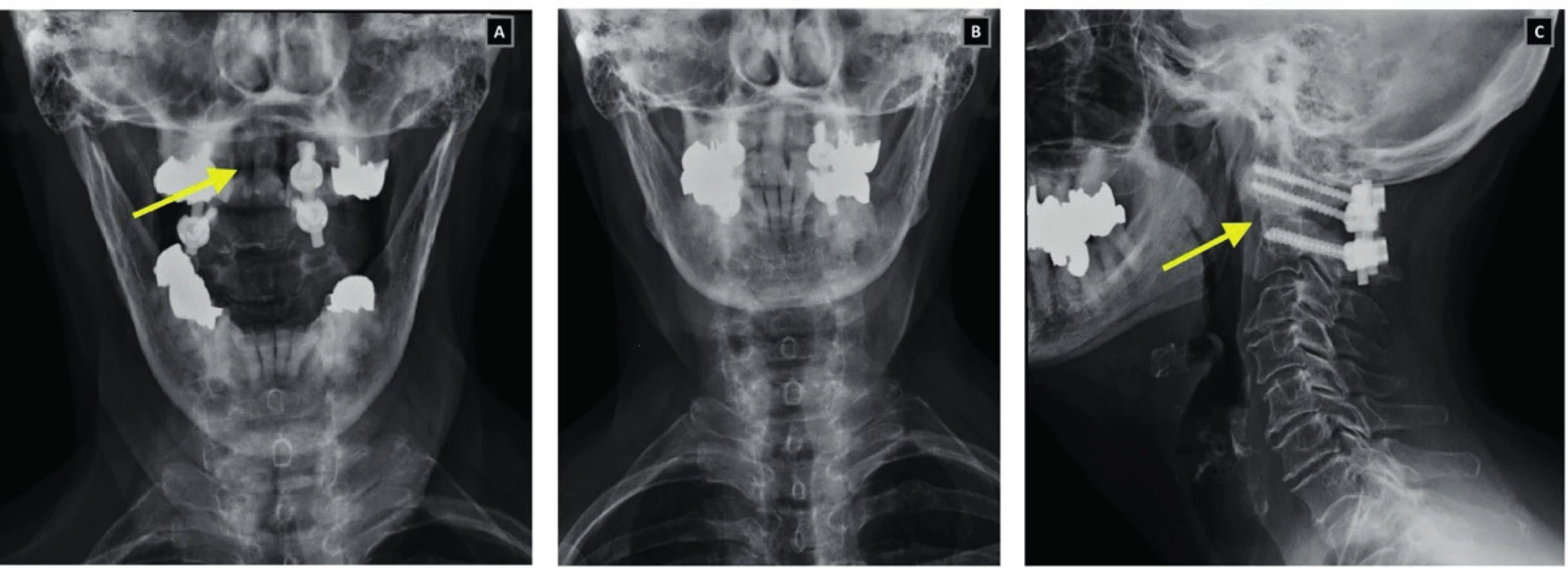 Cervical spine x-ray images in transoral (A), AP (B) and lateral (C) projection as well as images of a patient after posterior C1-2 fusion according to Harms. The arrow shows the location of the fracture