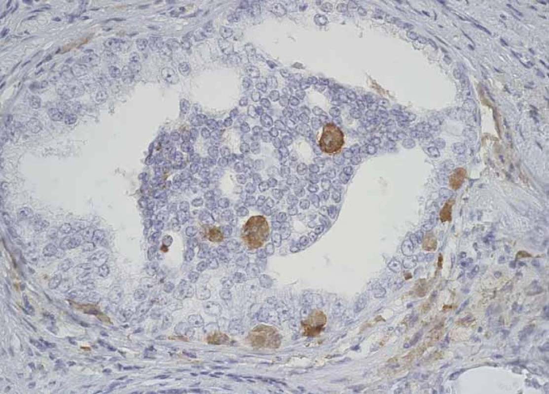 CD204+ macrophages infi ltrating structures of prostatic intraepithelial neoplasia.