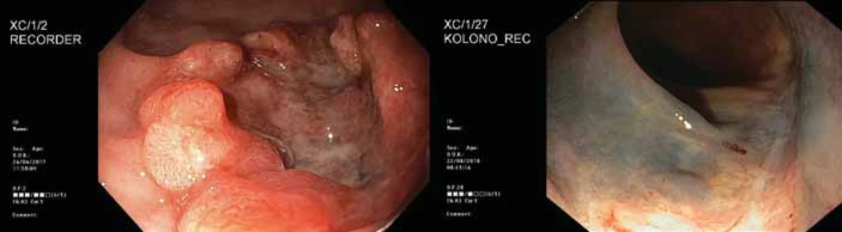 2. Endoskopický obraz nádoru před léčbou (vlevo) a půl roku po operaci (vpravo).