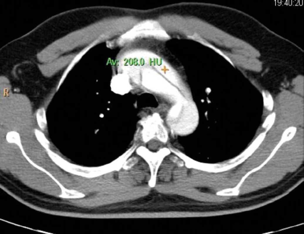 CT vyšetrenie, ascendentná aorta