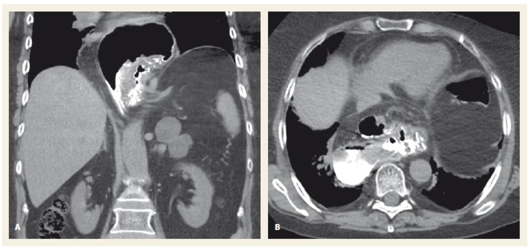 CT vyšetření břicha, kontrastní látka podaná per os, koronární rovina (A), transverzální rovina (B). Objemná herniace
žaludku do hrudníku při organoaxiálním volvulu žaludku.<br>
Fig. 4. Abdominal CT scan, oral contrast dye, coronal plane (A), transversal plane (B). A large herniation of the stomach
to thoracic cavity with an organoaxial stomach volvulus.
