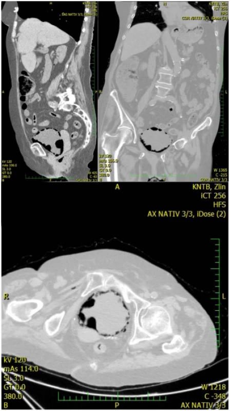 Počítačová termografie; plyn
ve stěně močového měchýře<br>
Fig. 2. Computed tomography, gas
in bladder wall