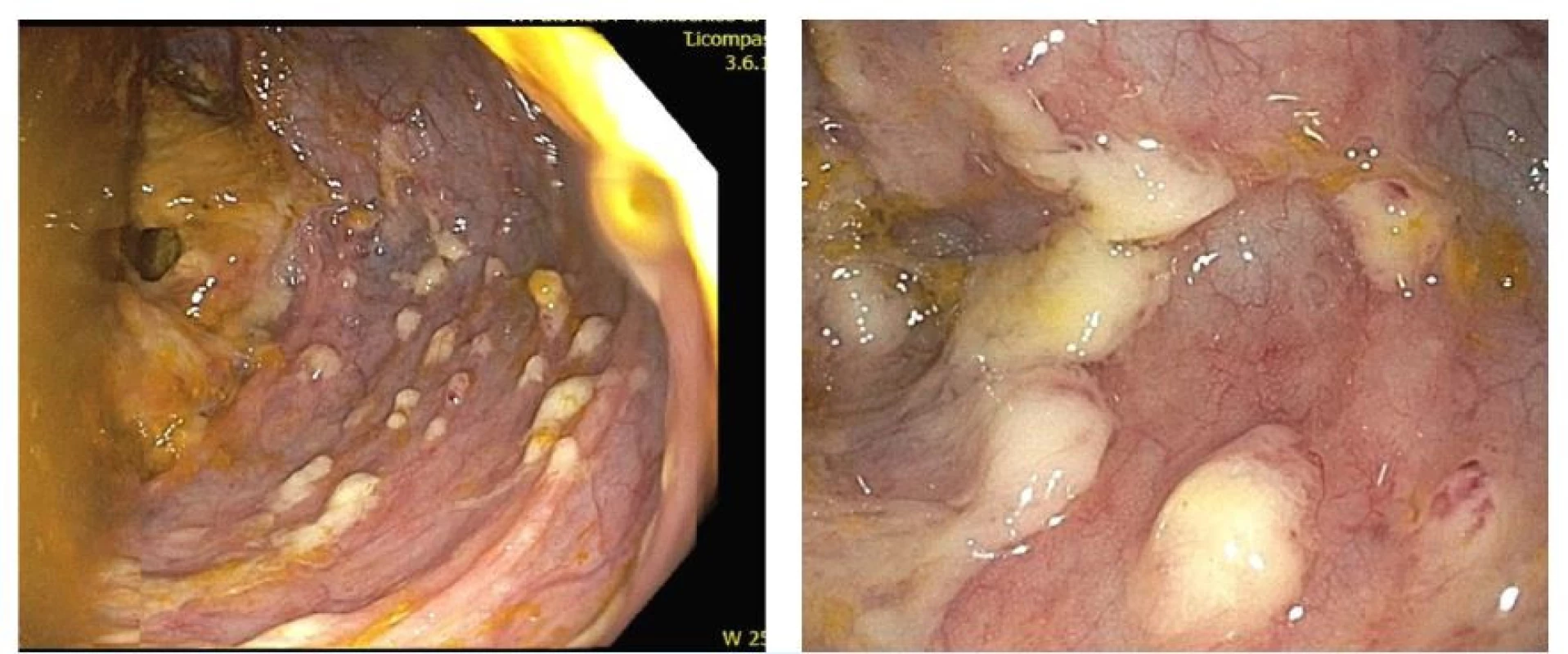 Endoskopický obraz bělavých pablán ulpívajících na sliznice tračníku u pacienta s CDI