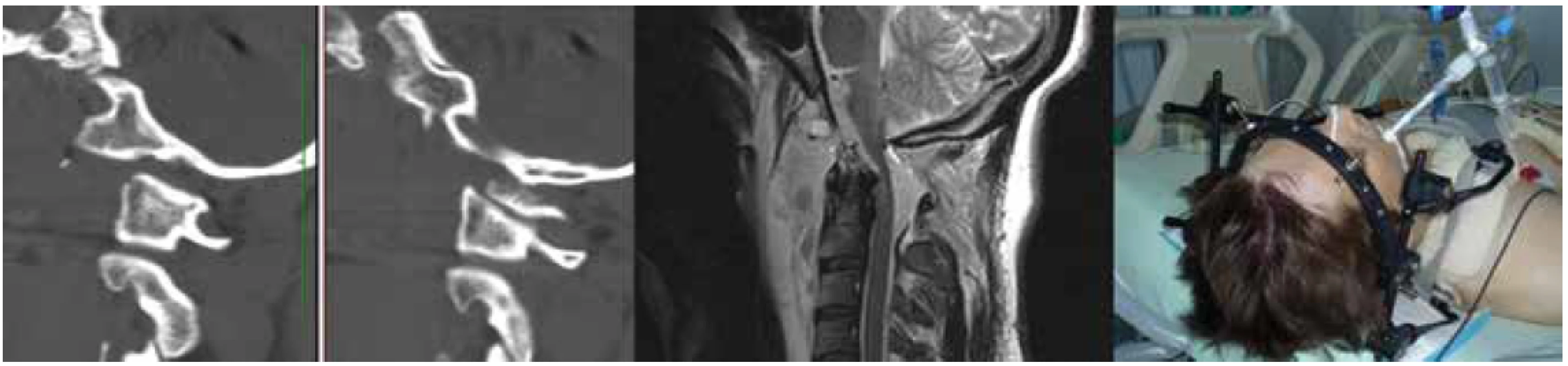 Pacient po úspěšné resuscitaci s kmenovou areflexií a korelujícím nálezem na MRI řešený konzervativně externí
halo fixací<br>
Na CT je patrná avulze okcipitálního kondylu.<br>
Fig. 2. A patient after successful CPR with brainstem areflexia and a graphic correlate on MRI, treated conservatively using
an external halo fixation<br>
Occipital condyle avulsion is shown on the CT scan.