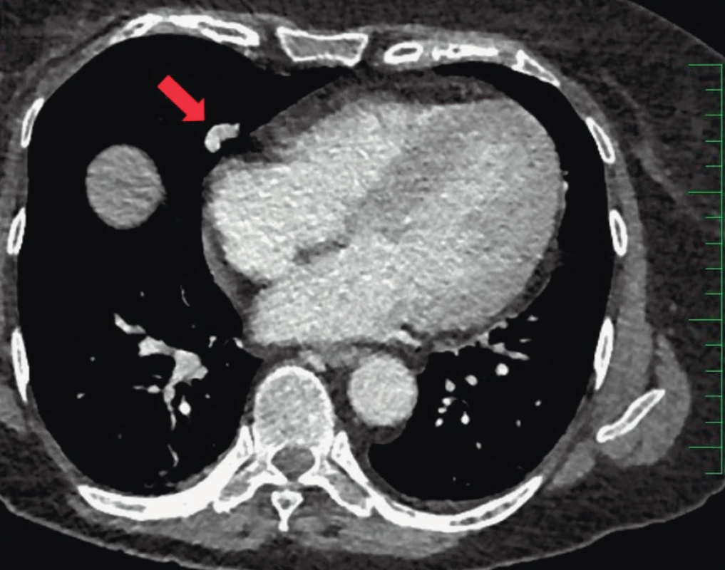 Axiální snímek postkontrastního CT plic – v plíci vpravo
ventrálně je patrná plicní arteriovenózní malformace indikovaná
k řešení na pracovišti intervenční radiologie